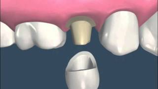 Preparación y colocación de Corona Unitaria - Estética Dental