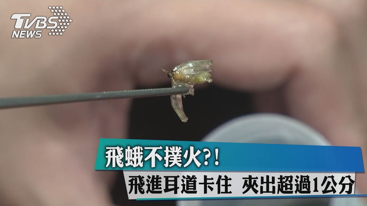 飛蛾不撲火?飛進耳道卡住 夾出超過1公分
