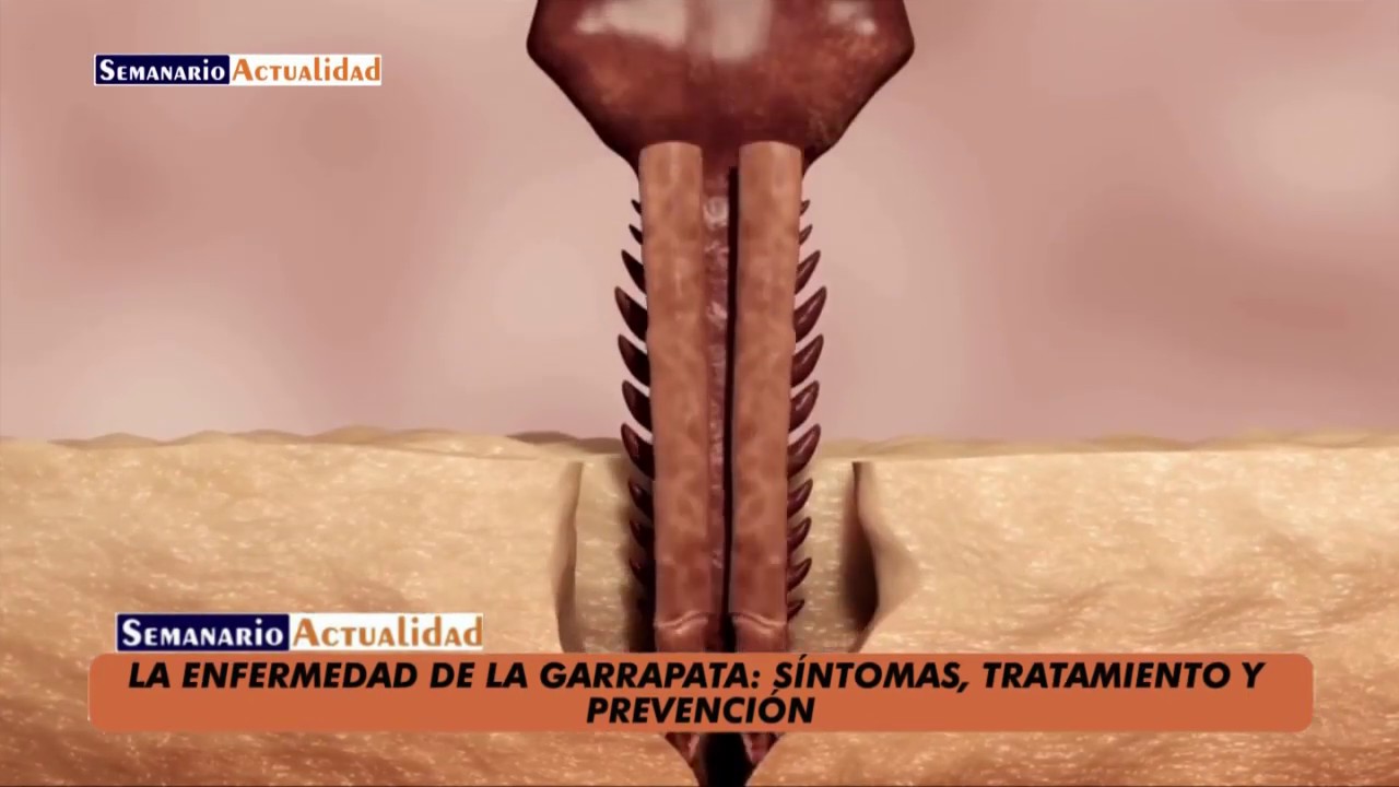 Watch La enfermedad de la garrapata: SĂntomas, tratamiento y prevenciĂłn Now La enfermedad de la garrapata: SĂntomas, tratamiento y prevenciĂłn