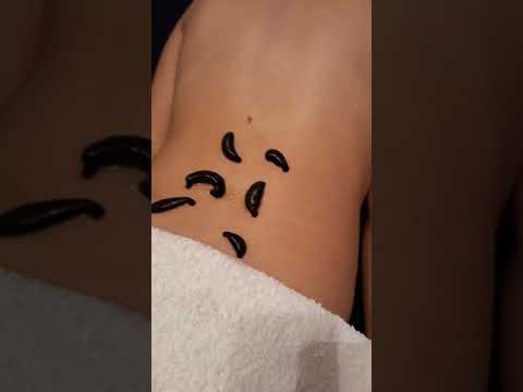 bioptron varicoza