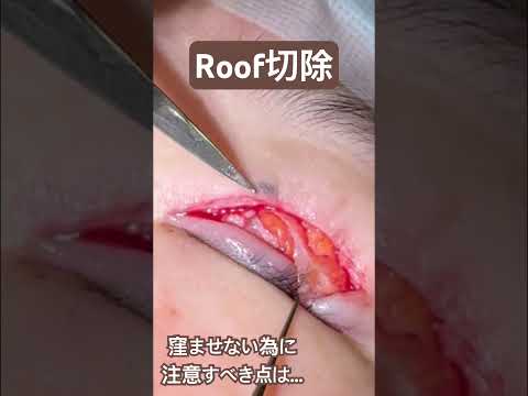 医学科 Roof切除の様子