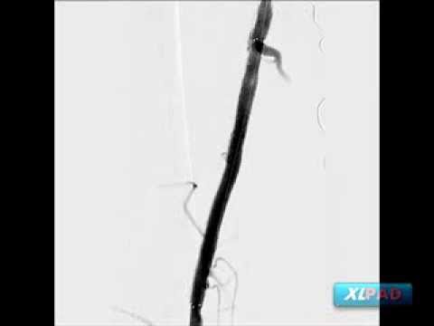 Mid SFA In-Stent Restenosis Treated with Angiosculpt and Viance