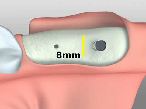 Smart Lift   Kit for Maxillary Sinus Lift with Crestal Approach