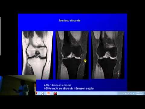 Golpe en la parte posterior del cuello debajo duele el cabello Torácica múltiples hemangiomas