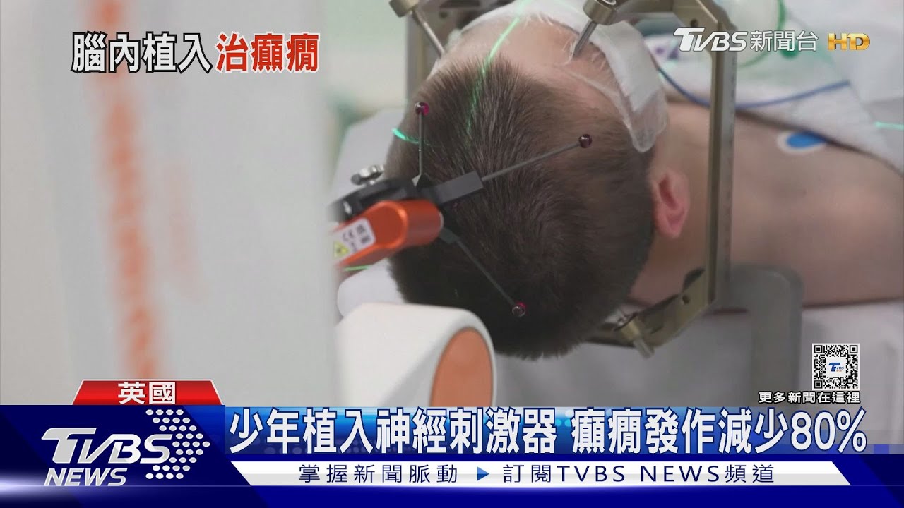 全球第一例! 英13歲少年植入神經刺激器治癲癇