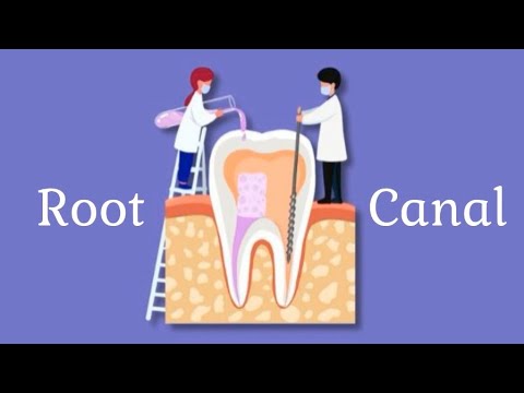 Root Canal Myths vs. Facts