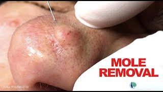 Removing a Mole.