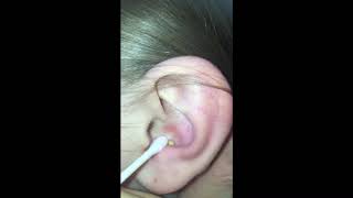 big pimple gets popped inside ear with a needle!!!!