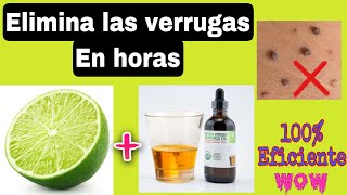 Cómo eliminar VERRUGAS en pocas horas con aceite de MORINGA. 100% Eficaz