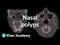 Nasal Polyps Respiratory System Diseases NCLEX RN Khan Academy