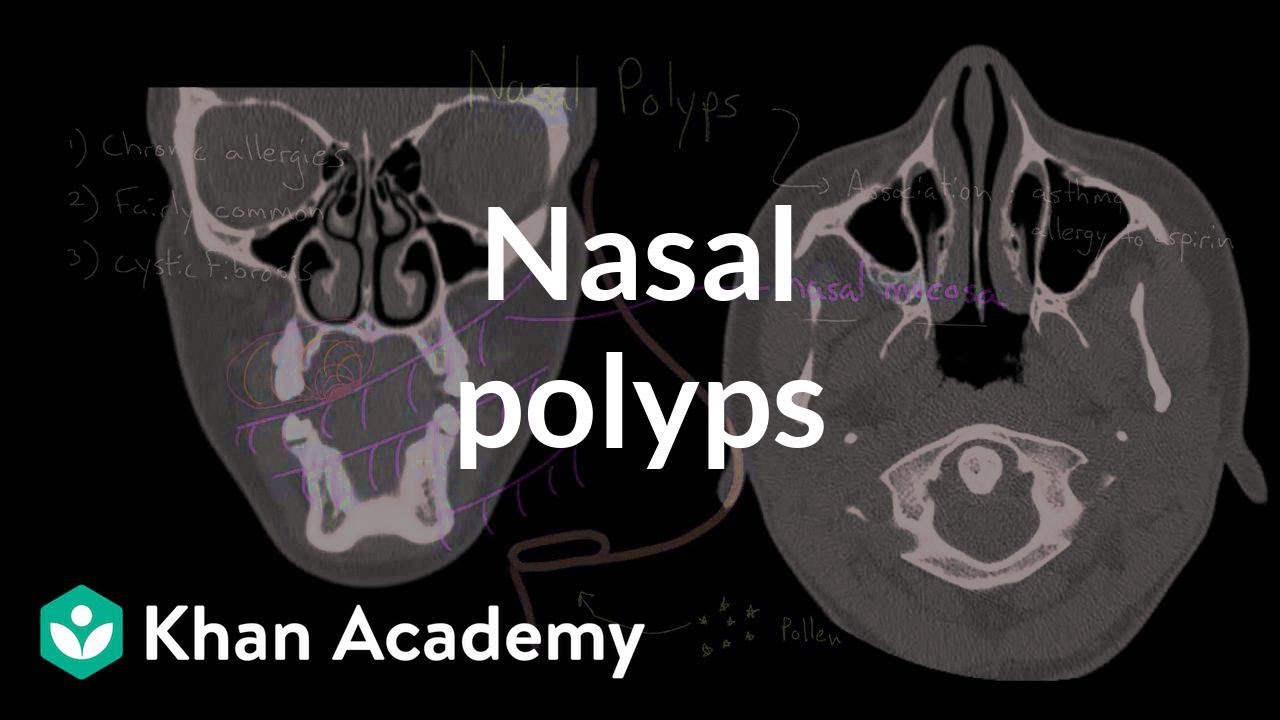 Nasal polyps | Respiratory system diseases | NCLEX-RN | Khan Academy - YouTube