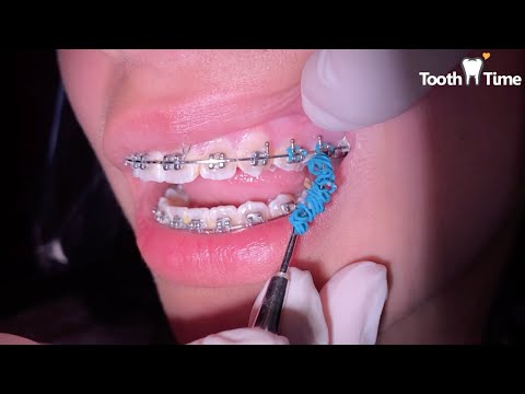 Braces Check ups - 4 months with rubber bands - Tooth Time Family Dentistry New Braunfels