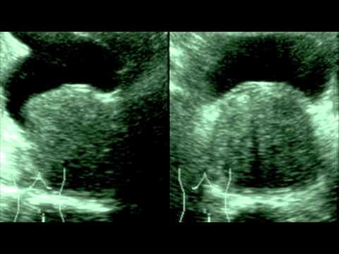 Klingt in der Prostata Calculous Prostatitis und ihre Symptome