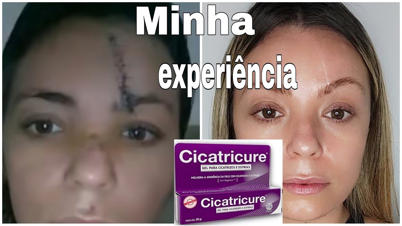CICATRICURE FUNCIONA?|| RESPONDENDO PERGUNTAS SOBRE MINHA EXPERIÊNCIA#cicatriz #cicatricure