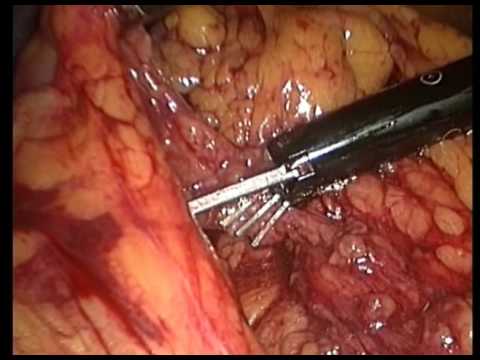 Multipe Polypes And Subtotal Excision Of The Colon