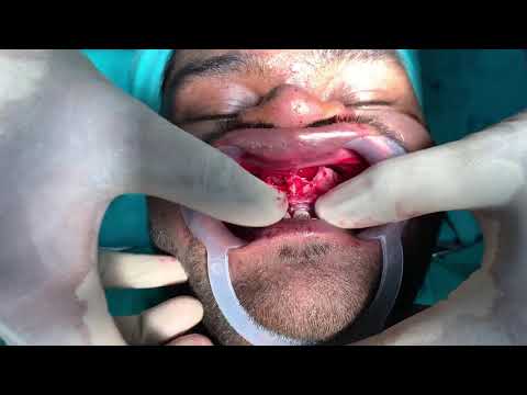 Downfracture Of The Maxilla Being Done With Just Finger Pressure After Lefort One Osteotomy