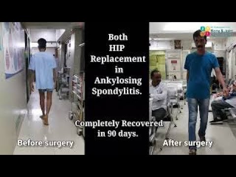 Both Hip Replacement Surgery In Ankylosing Spondylitis In Mulund | Hip Surgery In Mulund | Mumbai

heck out the video of Anil Malhar as there was pain in his both hips. He undergone both hip replacement surgery in ankylosing spondylitis in Mulund. His views for his hip surgery in Mulund under Dr. Shailendra Patil, who is best hip replacement surgeon in Mumbai.

For Consultation visit
Bone and Joint Care Centre Thane & Mulund
• Aditi Hospital Mulund ‘Alhad 185/R’, Opp. Kalidas Sports Complex, Purushottam Kheraj Rd,  Mulund West, Mumbai, Maharashtra 400080
Or 
Currae Specialty Hospital Ground Floor, C/O Highstreet Mall, next to big bazaar, Kapurbawdi, Thane (W, Thane, Maharashtra 400607

Call : 083690 26337 to book appointment.