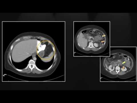 Emergent Complications of Bariatric Surgery |  Interesting Radiology Cases