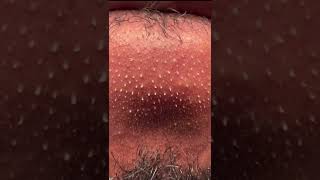 How to Remove oil in your Chin to prevent blackheads and pimples. Gently