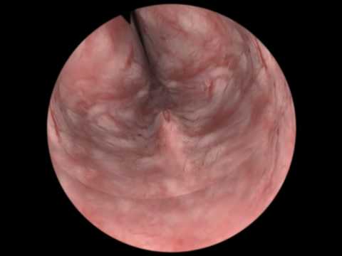Antibiotika mit Prostata-Adenom nach der Operation Fokale und diffuse Veränderungen der Prostata