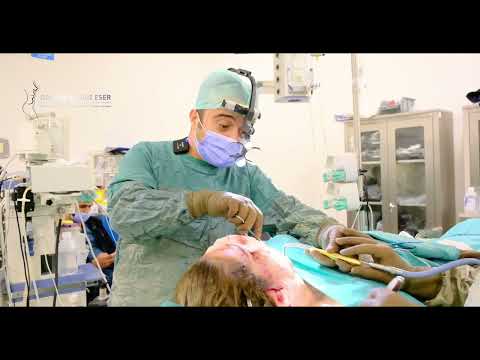 Wie führen wir ein Facelift durch?