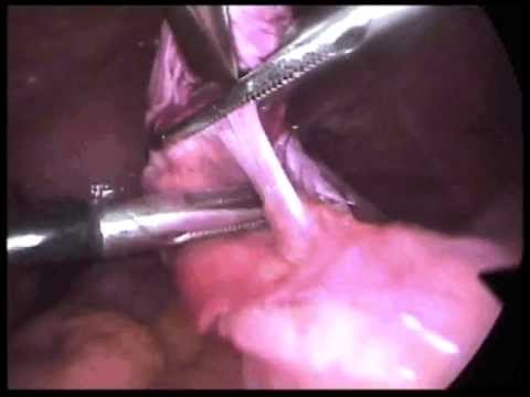 comment soigner kyste rein