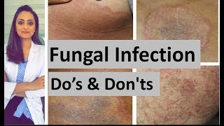 Fungal infection of skin | Do