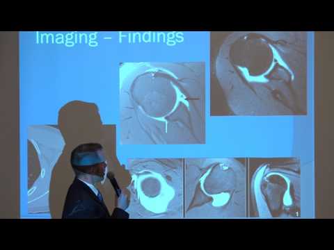 Dr. John Guzzo Discusses Shoulder Labral Tears and Repair