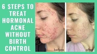 Treat hormonal acne without birth control - fast!