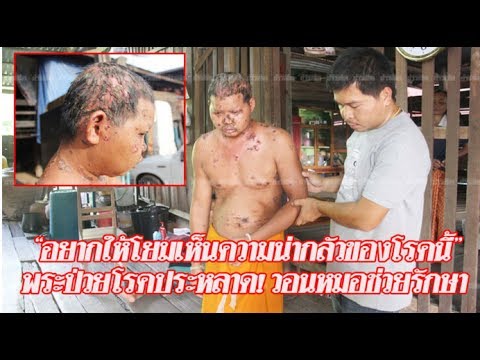 กลากโรคเบาหวาน กลากในการตั้งครรภ์