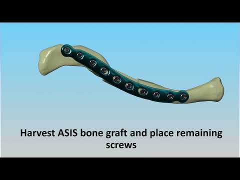 Clavicle Malunion Virtual Surgical Planning