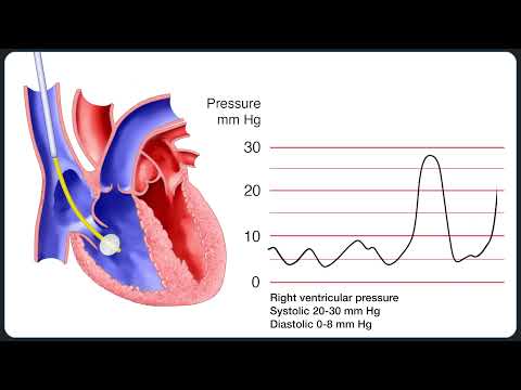 Einführen eines Pulmonalarterienkatheters (Swan-Ganz)