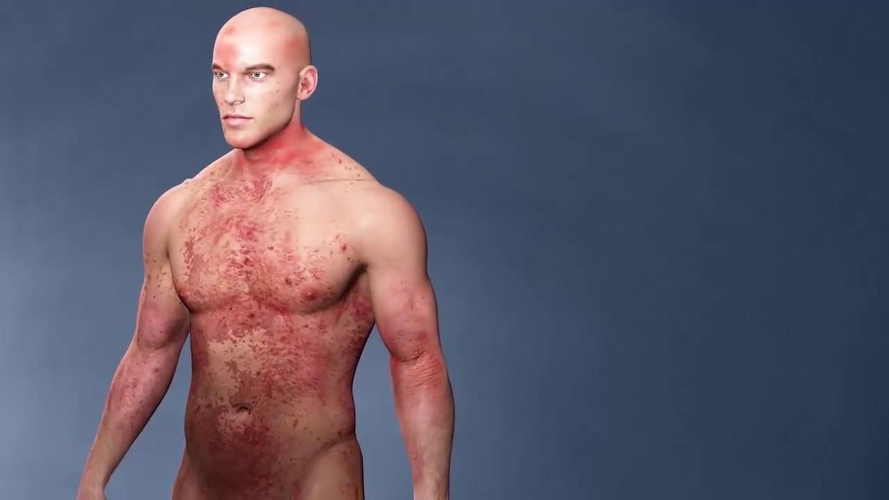 La dermatite atopique : boucle infernale