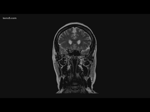 Verify: Yes, a simple slip and fall can cause a brain bleed resulting in death