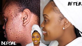 HOW TO GET RID OF ACNE SCARS AND DARK MARKS FAST | DIY TURMERIC, HONEY, LEMON, AND ALOE FACE MASK