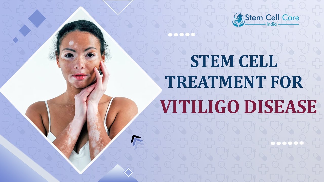 Vitiligo | Stem Cell Treatment For Vitiligo | Best Stem Cell Hospital For Skin Disease In Delhi