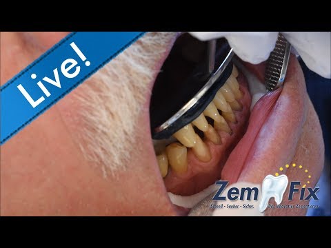 Six (6) anterior ceramic crowns inserted easily at once with ZemFix®