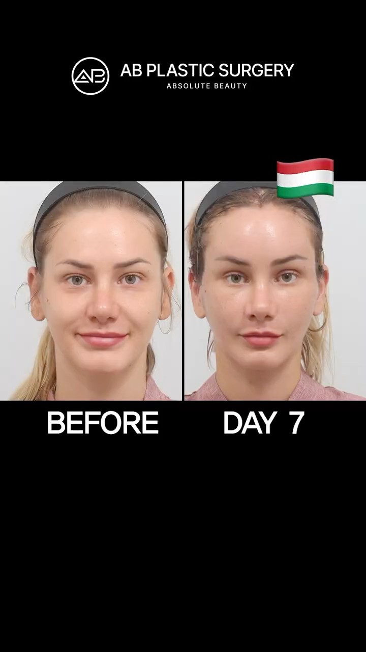 She Fixed Her Smile Lines with a Korean Facelift
