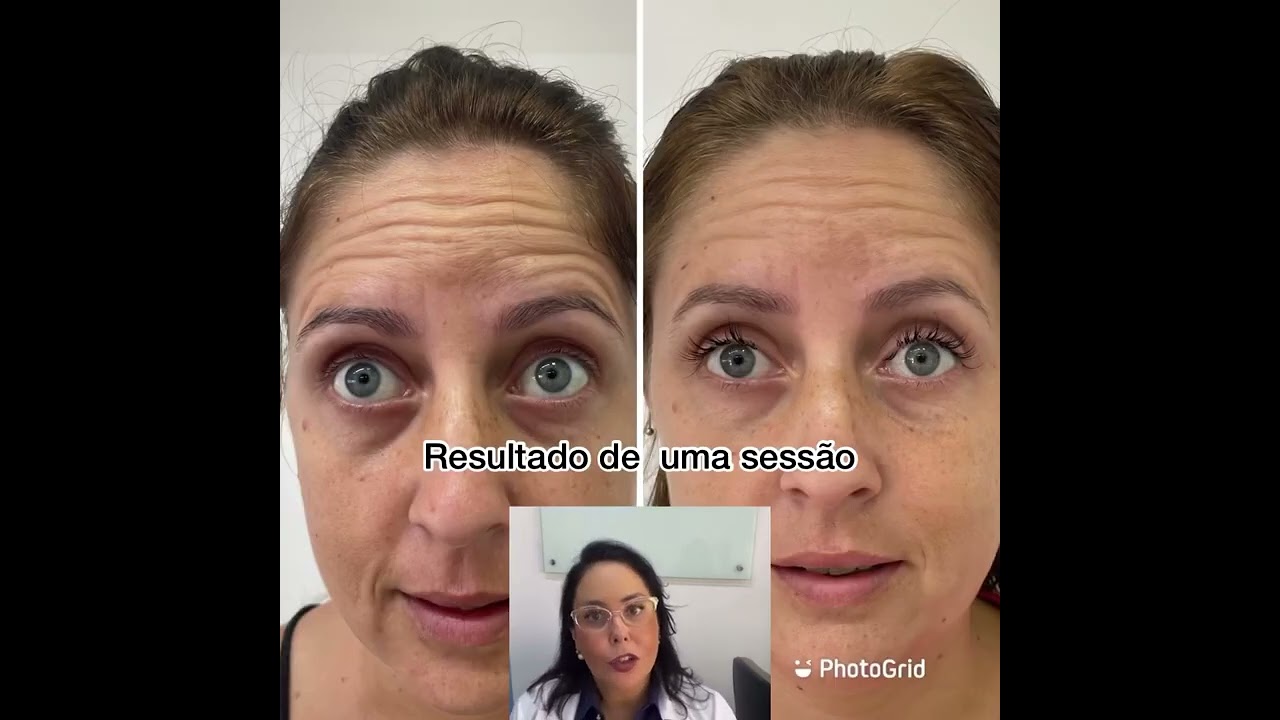 Watch Now Fios de Seda Fibroína (para o rosto) Fios de Seda Fibroína (para o rosto)