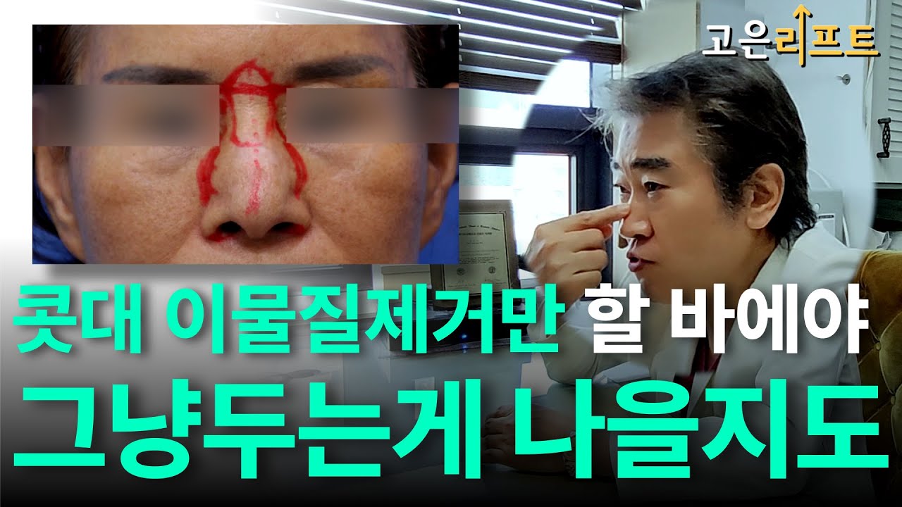 고은리프트 필러 이물질제거 및 녹이기 유튜브 영상