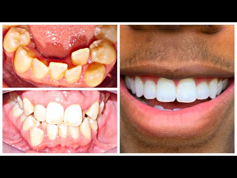 MY 3 YEAR TEETH JOURNEY!! | Before & After Braces