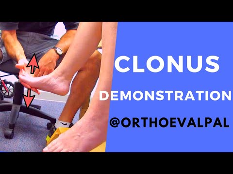 Hoffman s sign positive How to perform the test