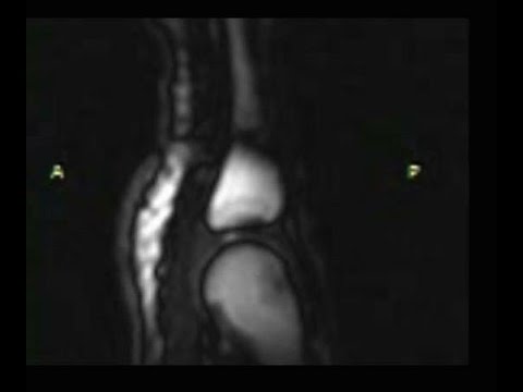 MRI movie peers inside cracking knuckles