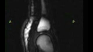 Popping your knuckles does not lead to arthritis!