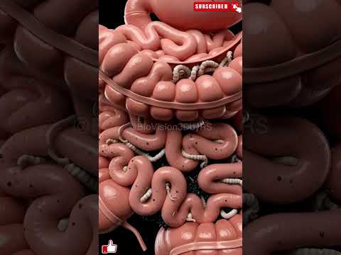 Digestive System Breakdown: Severe Constipation & Parasites in 3D