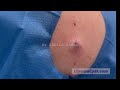 Blackhead Extraction Dr Khaled Sadek LipomaCyst Com