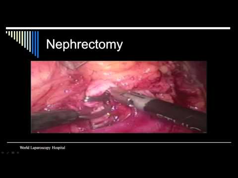 Laparoscopic Nephrectomy