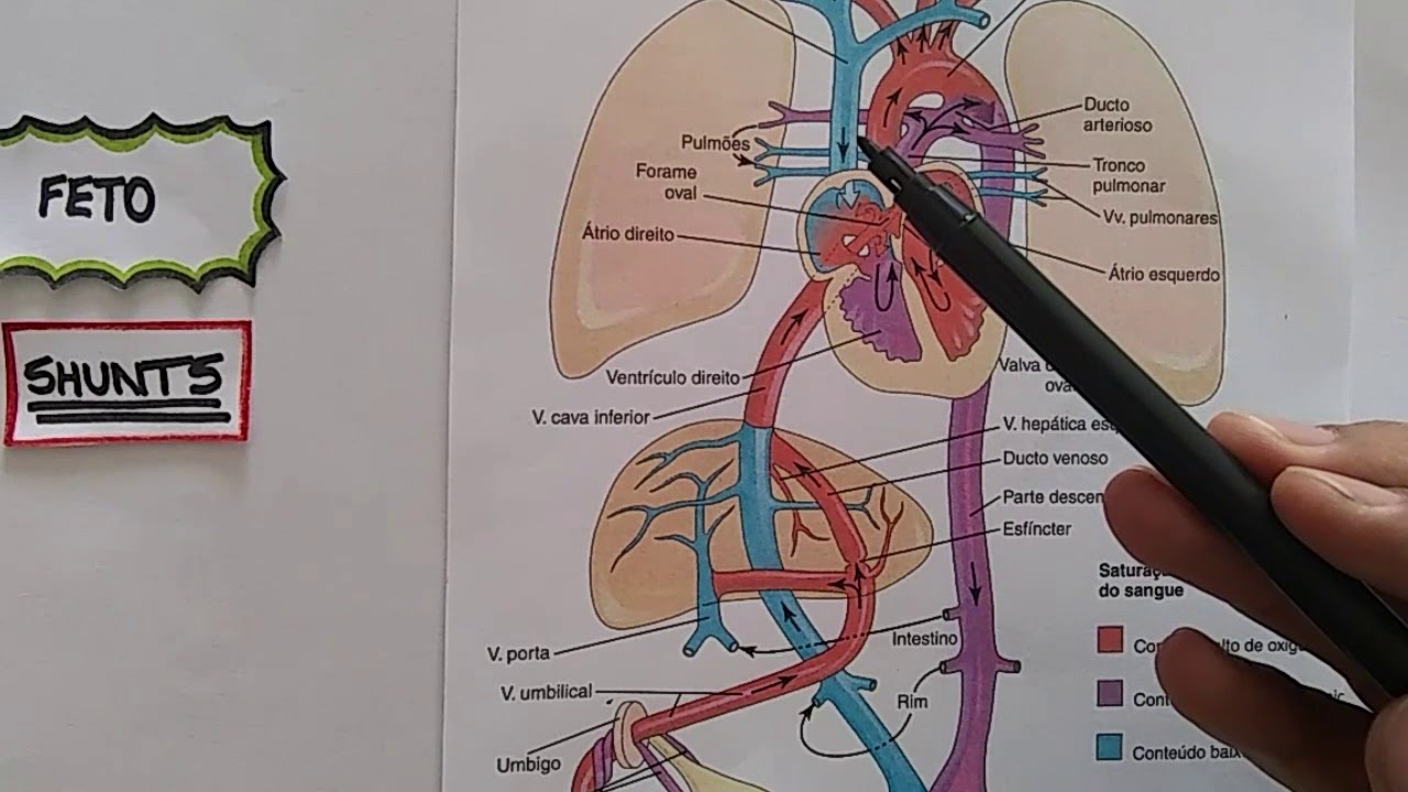 Persistência do ducto arterioso
