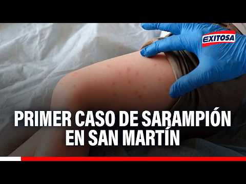 🔴🔵 Se trata de un niño de cuatro años, quien tenía su esquema de vacunación incompleto