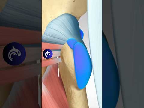 Cam Impingement Open Repair 3D Animation No Narration